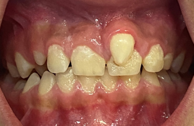 牙齒基因異?；驒z測