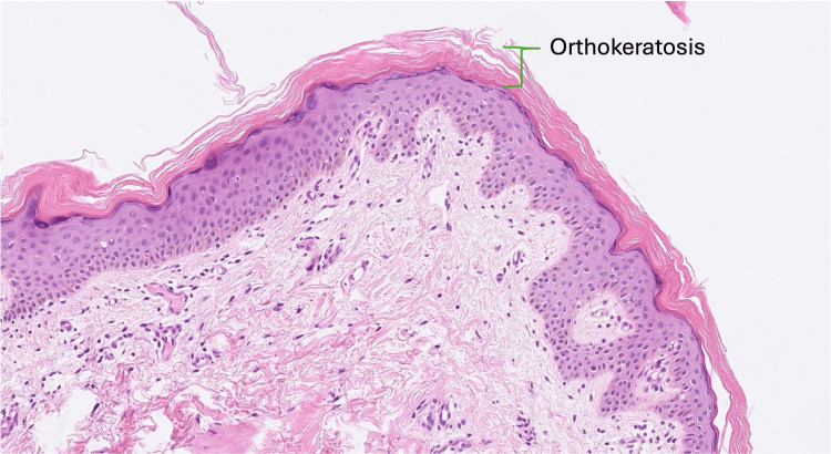 圖3. 魚鱗病皮膚活檢的組織病理學。